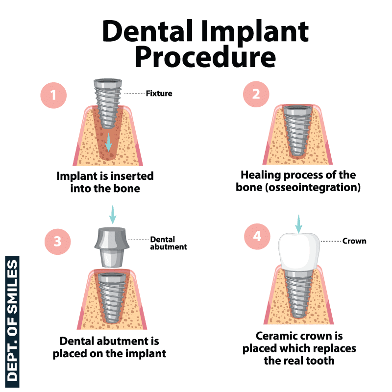 Dental implant treatment process in Pearland, TX
