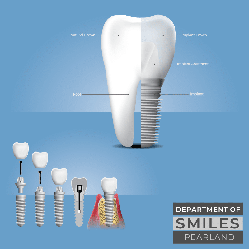Dental implants and missing tooth replacement in Pearland, TX
