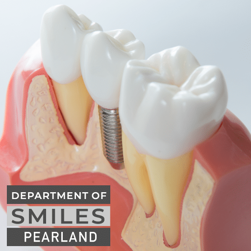 Ceramic dental crown treatment in Pearland, TX