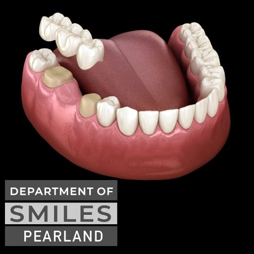 Dental bridge for missing tooth replacement in Pearland, TX